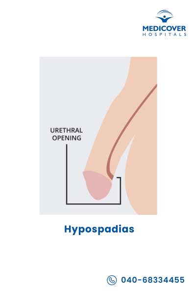 Hypospadias