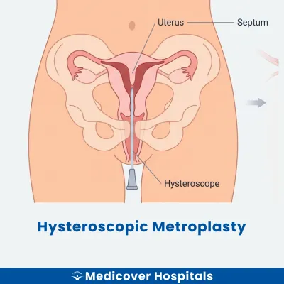 Hysteroscopic Metroplasty