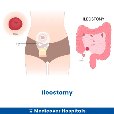 Ileostomy