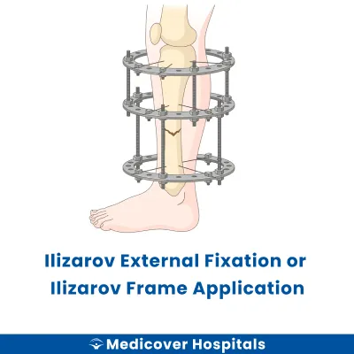 Ilizarov External Fixation Or Ilizarov Frame Application