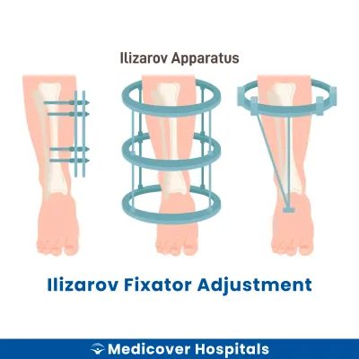 Ilizarov Fixator Adjustment