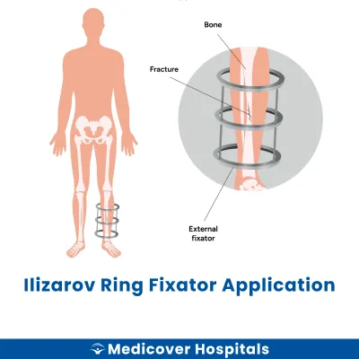 Ilizarov Ring Fixator Application