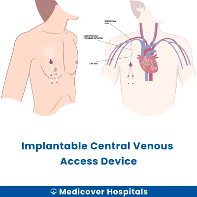 Implantable Central Venous Access Device