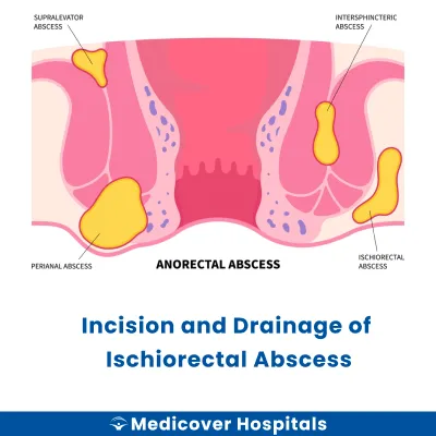 Incision and Drainage of Ischiorectal Abscess