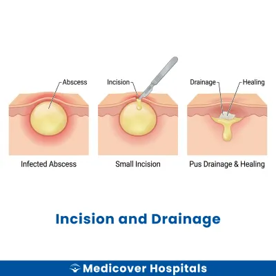 Incision and Drainage