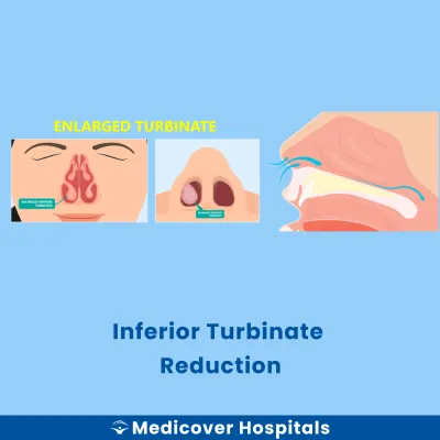 Inferior Turbinate Reduction