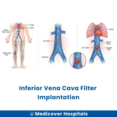 Inferior Vena Cava Filter Implantation