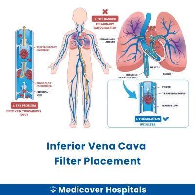 Inferior Vena Cava Filter Placement