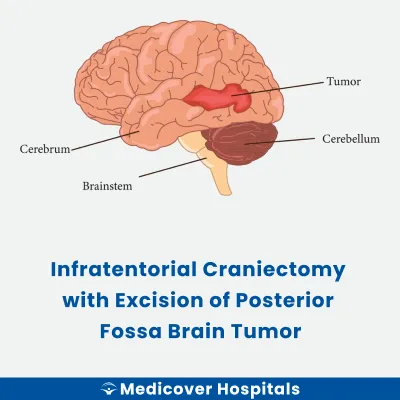 Infratentorial Craniectomy With Excision of Posterior Fossa Brain Tumor