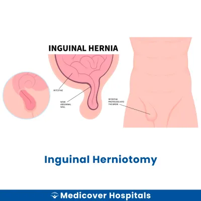 Inguinal Herniotomy