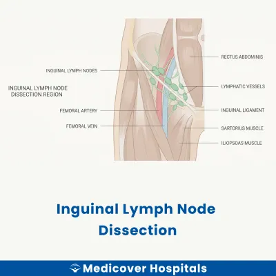 Inguinal Lymph Node Dissection