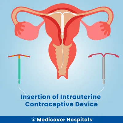 Insertion of Intrauterine Contraceptive Device