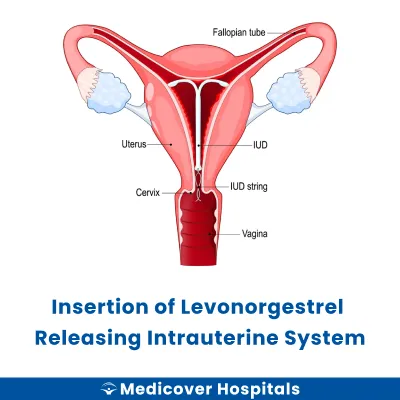 Insertion of Levonorgestrel Releasing Intrauterine System