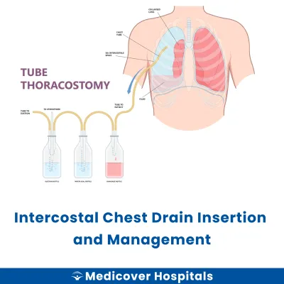 Intercostal Chest Drain Insertion and Management