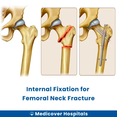 Internal Fixation for Femoral Neck Fracture
