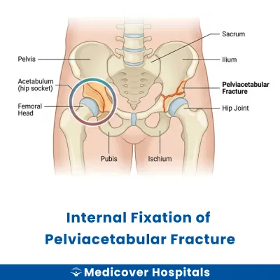 Internal Fixation of Pelviacetabular Fracture