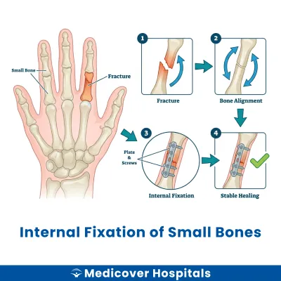 Internal Fixation of Small Bones