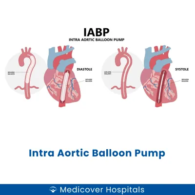 Intra Aortic Balloon Pump