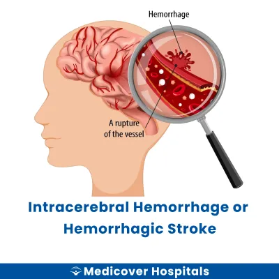 Intracerebral Hemorrhage Or Hemorrhagic Stroke