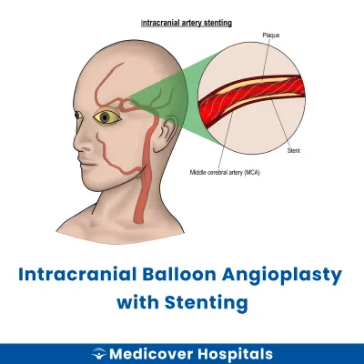Intracranial Balloon Angioplasty With Stenting