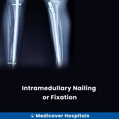 Intramedullary Nailing Or Fixation