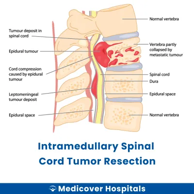 Intramedullary Spinal Cord Tumor Resection