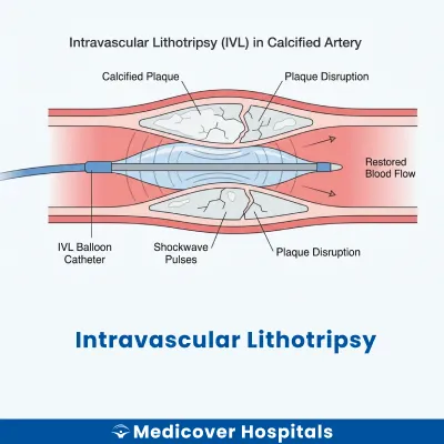 Intravascular Lithotripsy