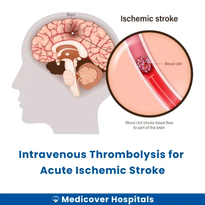Intravenous Thrombolysis for Acute Ischemic Stroke