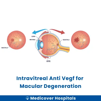 Intravitreal Anti Vegf for Macular Degeneration