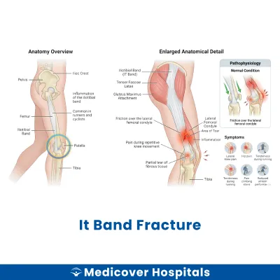 It Band Fracture