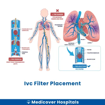 Ivc Filter Placement