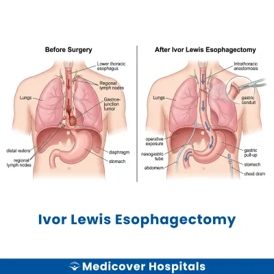 Ivor Lewis Esophagectomy