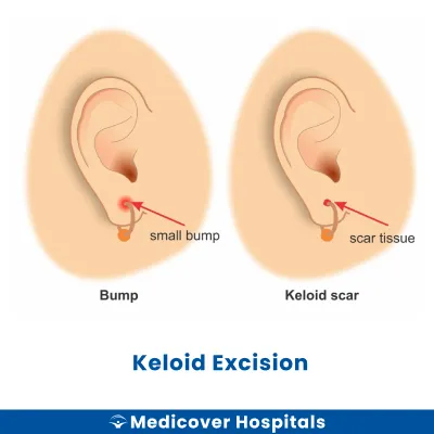 Keloid Excision