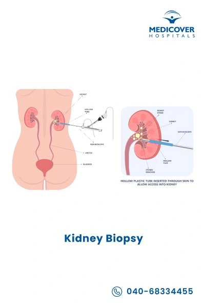 kidney-biopsy