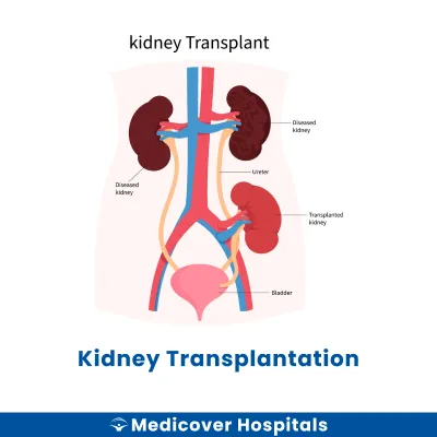 Kidney Transplantation