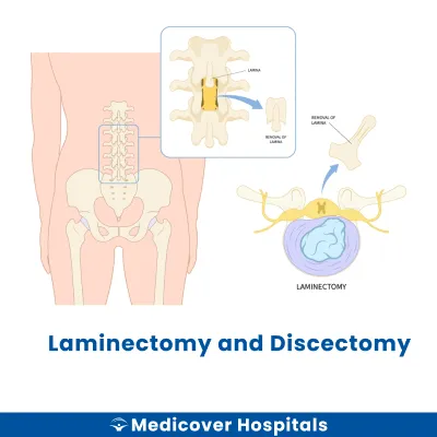 Laminectomy and Discectomy