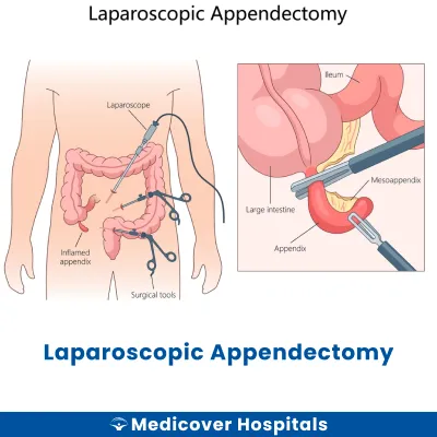 Laparoscopic Appendectomy