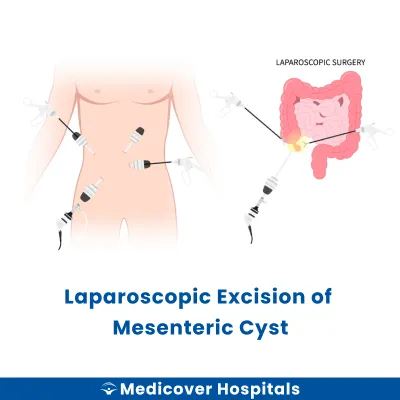 Laparoscopic Excision of Mesenteric Cyst