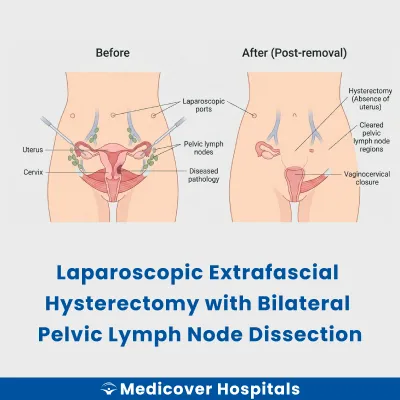 Laparoscopic Extrafascial Hysterectomy With Bilateral Pelvic Lymph Node Dissection