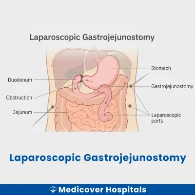 Laparoscopic Gastrojejunostomy
