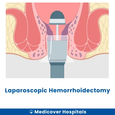 Laparoscopic Hemorrhoidectomy