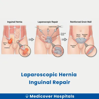 Laparoscopic Hernia Inguinal Repair