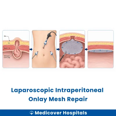 Laparoscopic Intraperitoneal Onlay Mesh Repair