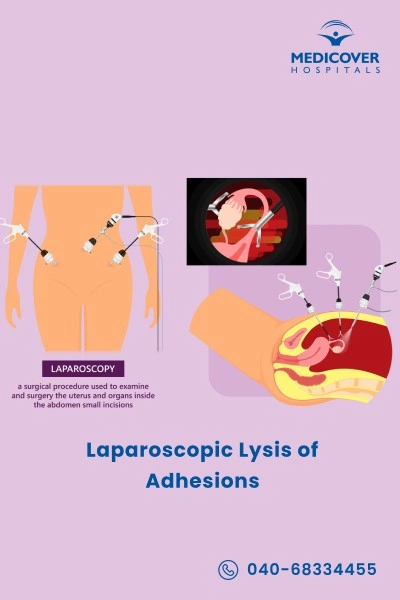 laparoscopic-lysis-of-adhesions