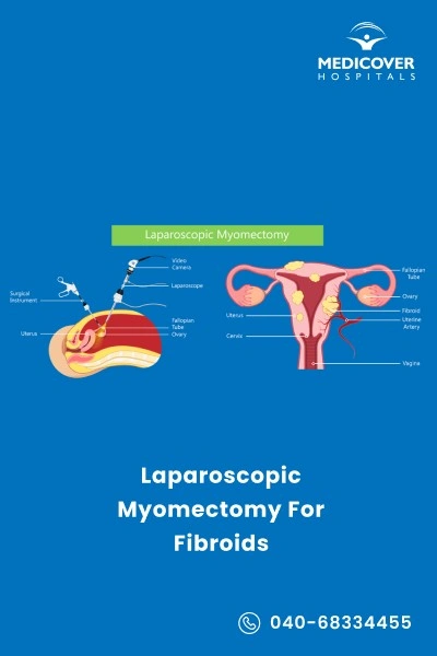 laparoscopic-myomectomy-for-fibroids