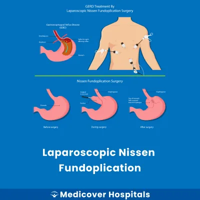 Laparoscopic Nissen Fundoplication