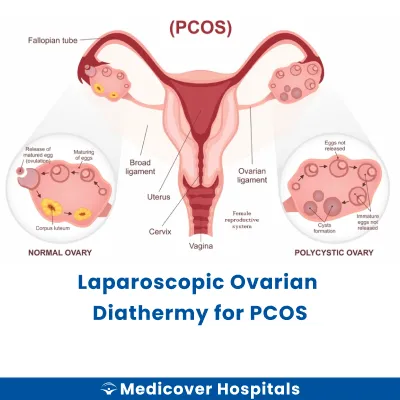 Laparoscopic Ovarian Diathermy for Pcos