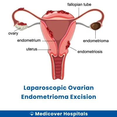 Laparoscopic Ovarian Endometrioma Excision
