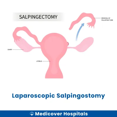 Laparoscopic Salpingostomy