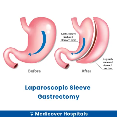 Laparoscopic Sleeve Gastrectomy